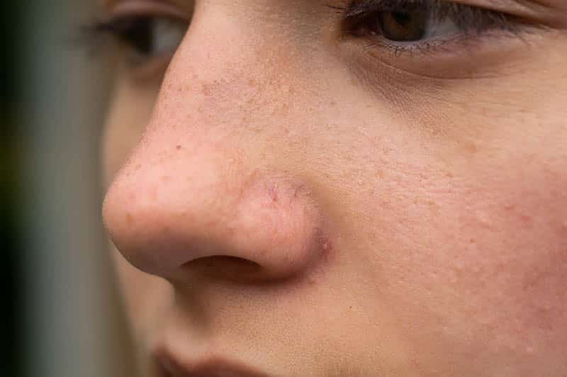 pores