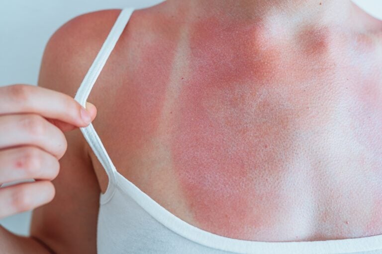 Swimsuit strap marks on young woman's sunburned skin